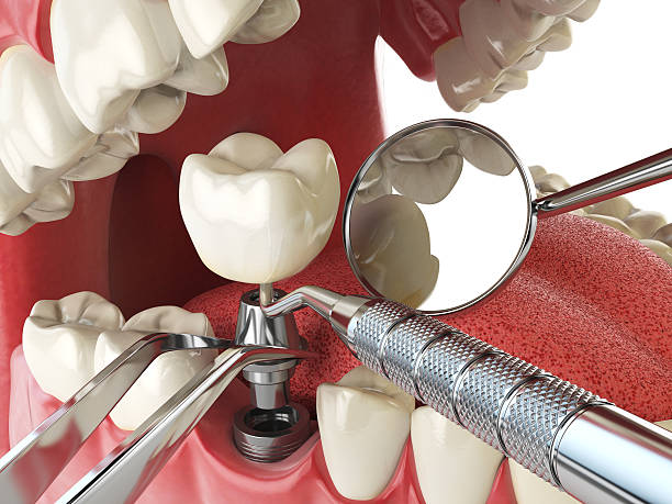 Best Emergency Dentist for Lost Fillings or Crowns in Fort Salonga, NY